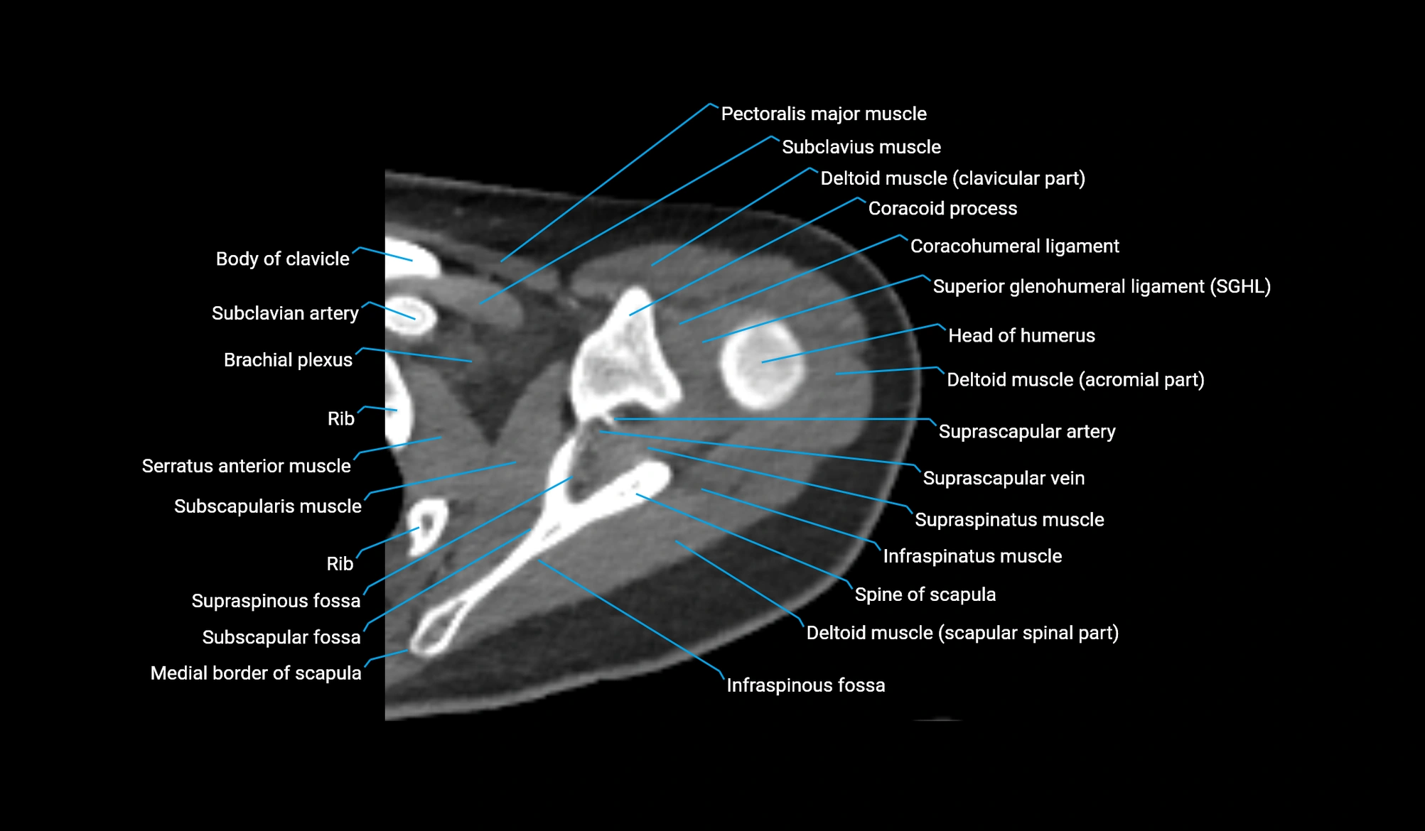 CT upper arm axial  cross sectional anatomy labelled radiology image -00078.webp